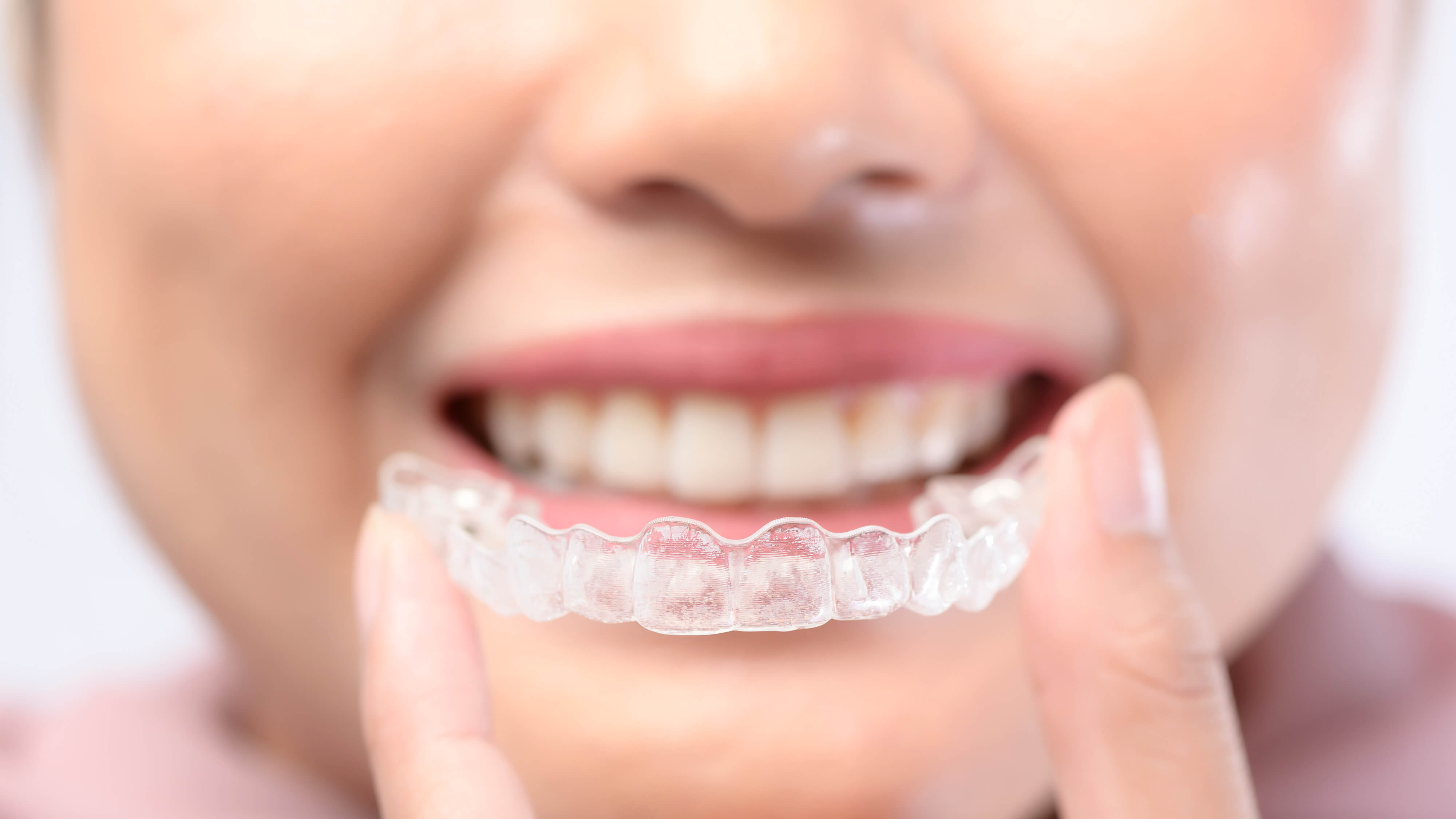 Braces vs Aligners