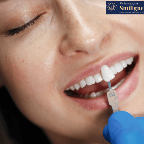 Benefits of Dental Veneers