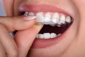 Clear Teeth Aligners