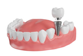 Implants vs Dentures