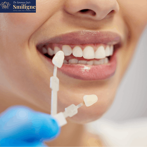 Benefits of Dental Veneers