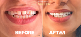 Smile Correction Cost