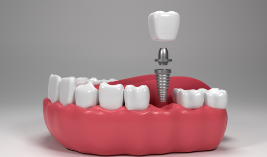 Best Dental Implants in Kochi