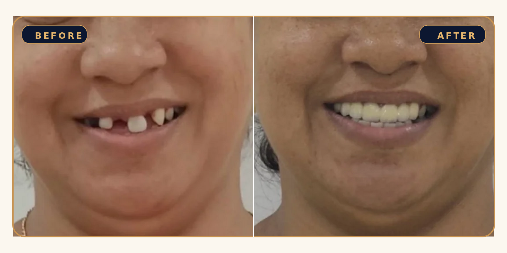 Spacing & Gap Closure - Before and After Result