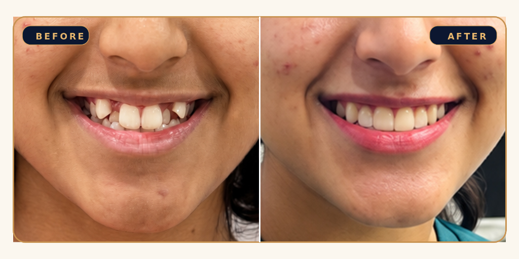 Crowding & Canine Correction - Before and After Result