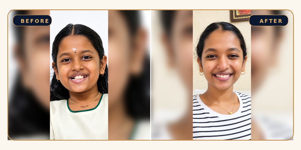 Early Orthodontic Transformation - Before and After Result