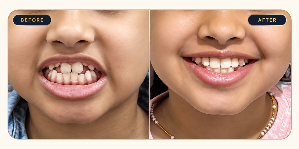 Deep Bite & Arch Expansion - Before and After Result