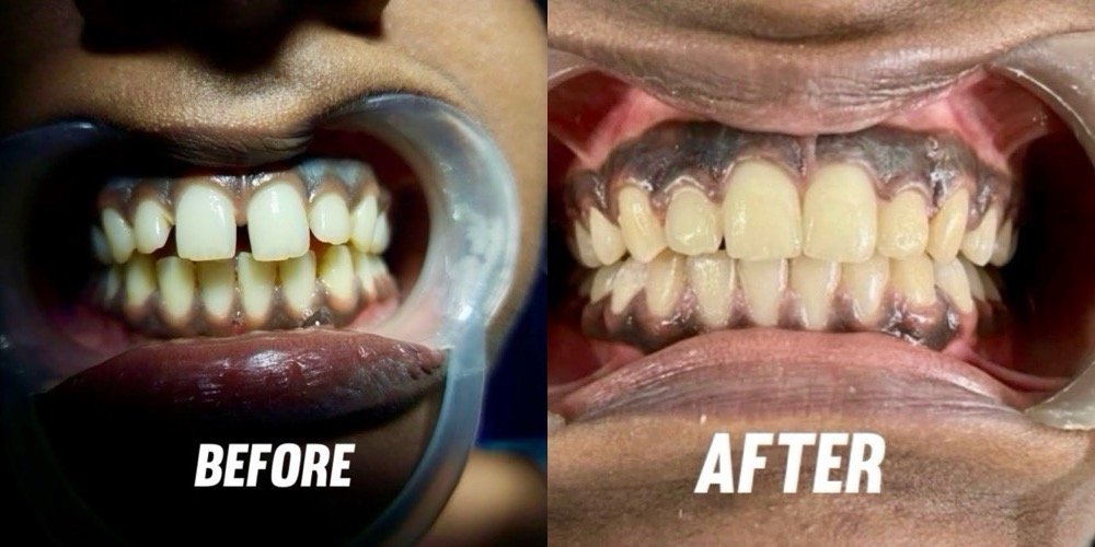 Invisalign Teeth Straightening Result
