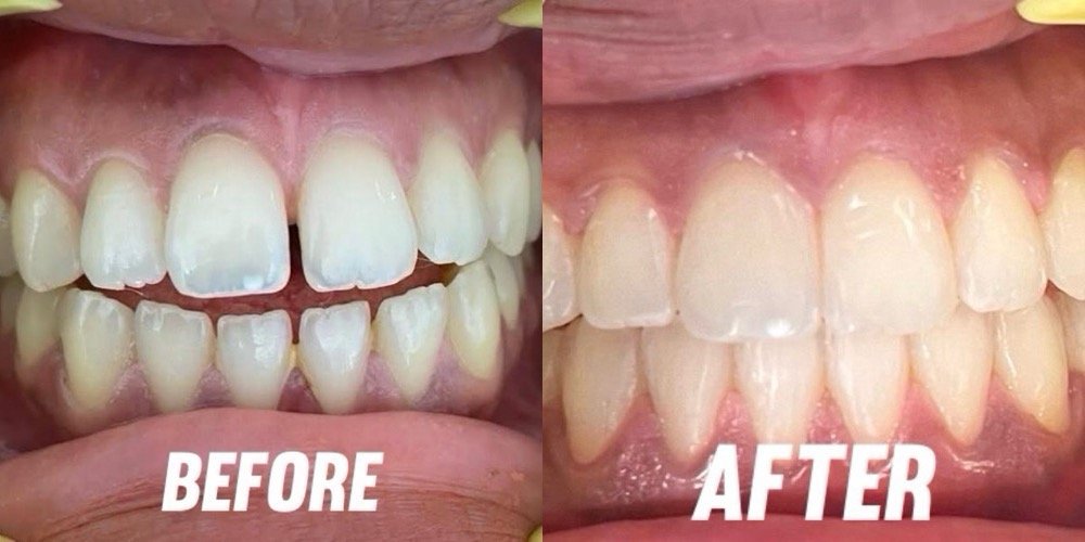 Patient Smile Transformation with Clear Aligners