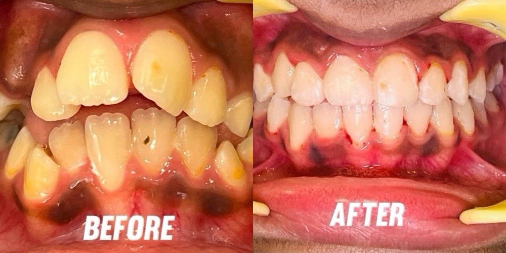 Clear Aligners Before and After Smile Transformation