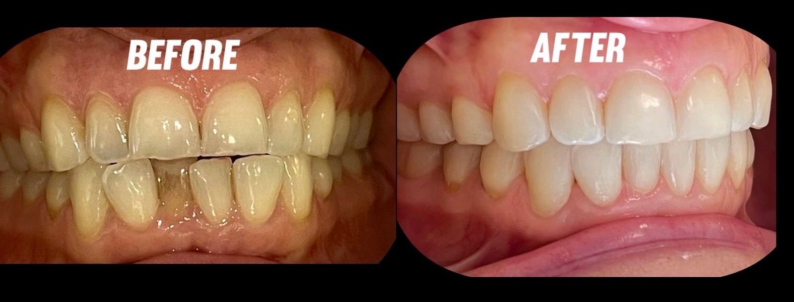 Smiligne Orthodontic Alignment Result