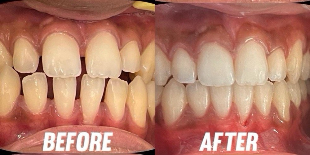 Invisible Aligners Smile Correction Before and After