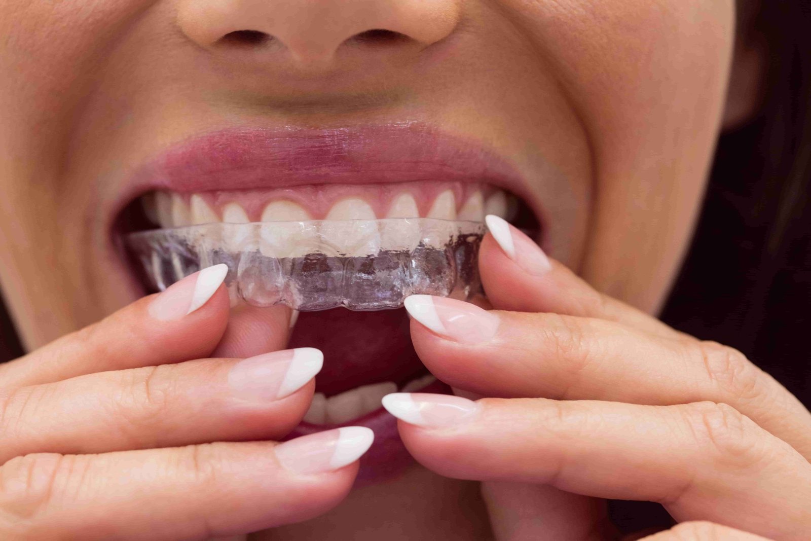 Best Invisible Teeth Aligners in Kochi