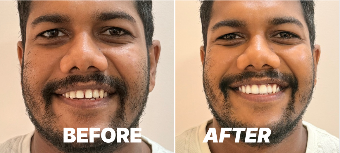 Before and After